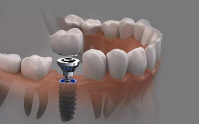 İmplant Tedavisi